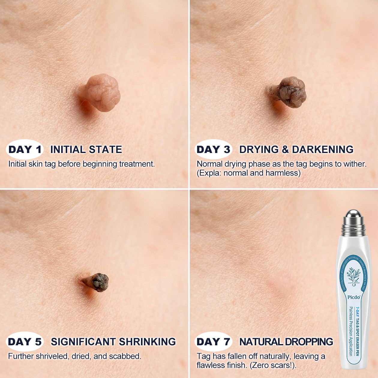 𝐏i𝐜𝐝o® 7-𝐷𝑎𝑦 𝗧𝐚𝐠 & 𝗦𝗽𝐨𝐭 𝐄𝐫𝒂𝒔𝒆𝒓(Zero Pain, Zero 𝐒𝐜𝐚𝒓𝒔 Rollerball)🌳🌳