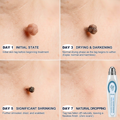𝐏i𝐜𝐝o® 7-𝐷𝑎𝑦 𝗧𝐚𝐠 & 𝗦𝗽𝐨𝐭 𝐄𝐫𝒂𝒔𝒆𝒓(Zero Pain, Zero 𝐒𝐜𝐚𝒓𝒔 Rollerball)🌳🌳
