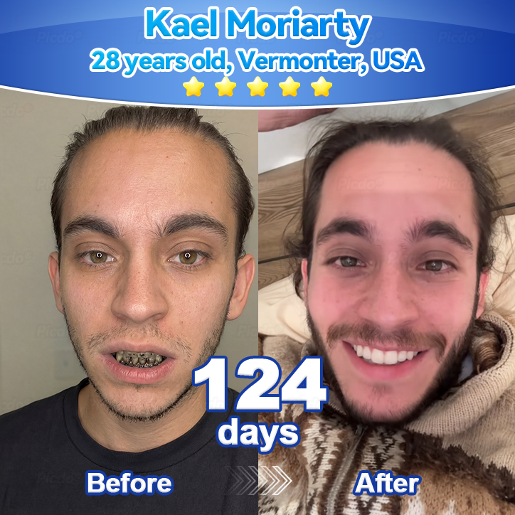 𝑃𝑖𝑐𝑑𝑜®👑🦷 𝑆𝑡𝑒𝑚 𝐶𝑒𝑙𝑙 𝐺𝑖𝑛𝑔𝑖𝑣𝑎𝑙 𝑅𝑒𝑝𝑎𝑖𝑟 𝑀𝑜𝑢𝑠𝑠𝑒(🦷Remove Tartar • Strengthen Gums • Deep Clean & Freshen Breath)🦹